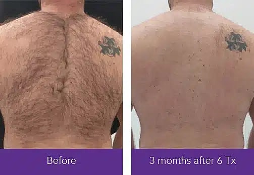 back-laser-hair-removal-mount-pleasant