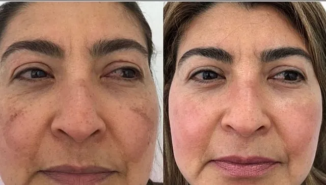melasma-treatment-near-me-mt-pleasant
