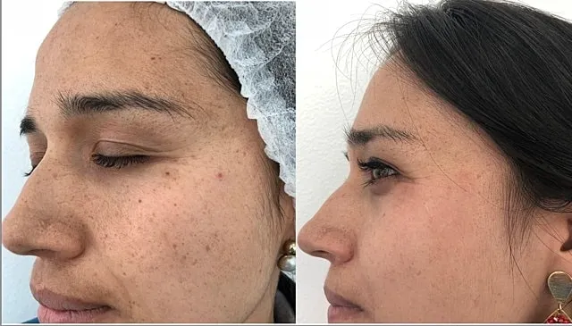 melasma-treatment-transformation