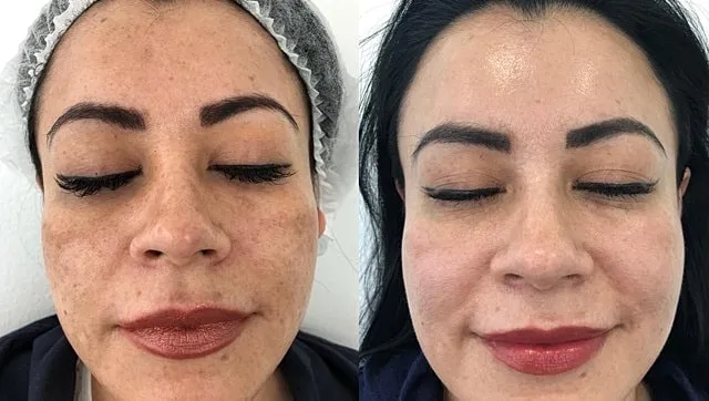 melasma-laser-before-after-treatment