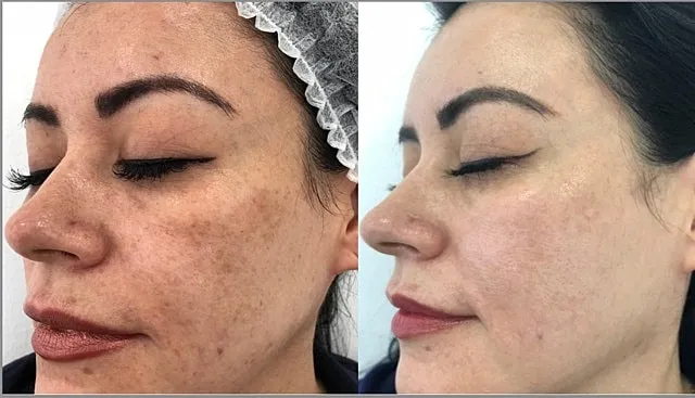 melasma-laser-treatment-before-after-sc