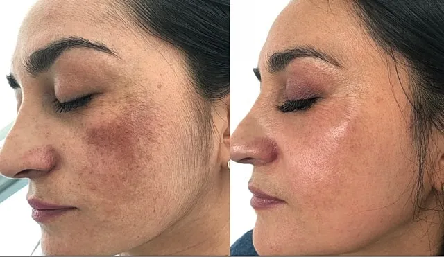 melasma-laser-treatment-before-and-after