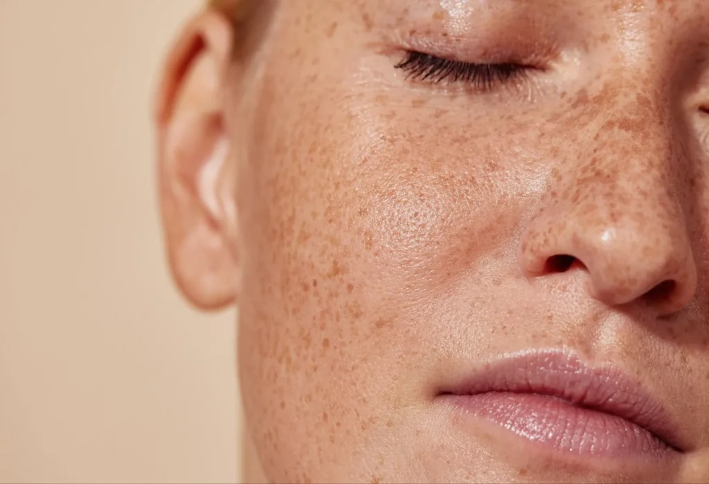 best-melasma-treatment-for-women